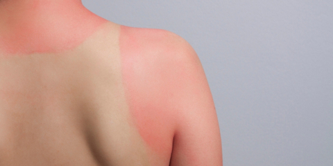Sunburned skin