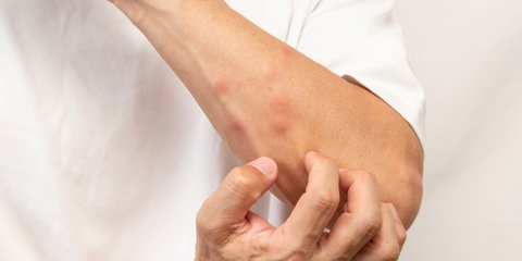 An arm with bug bites