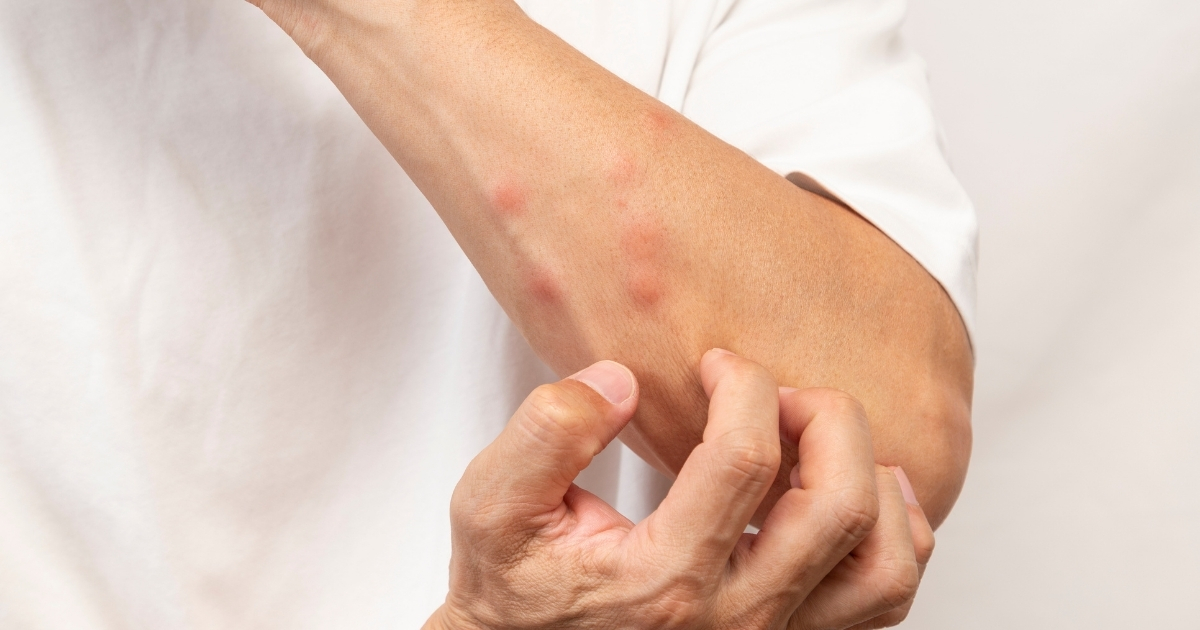 An arm with bug bites